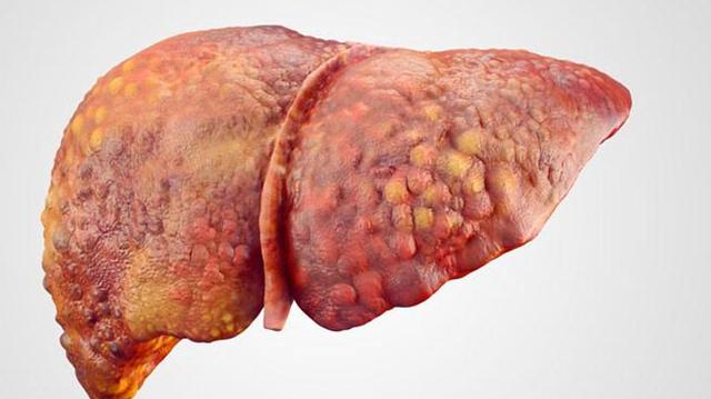 肝硬化就是肝癌吗?